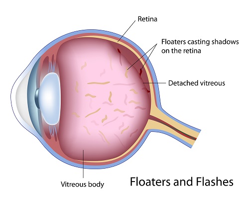Floaters Flashes Retina Mount