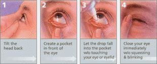 Comment utiliser des gouttes pour les yeux