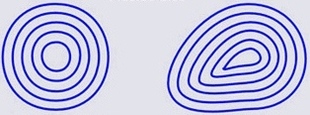 Keratoconus