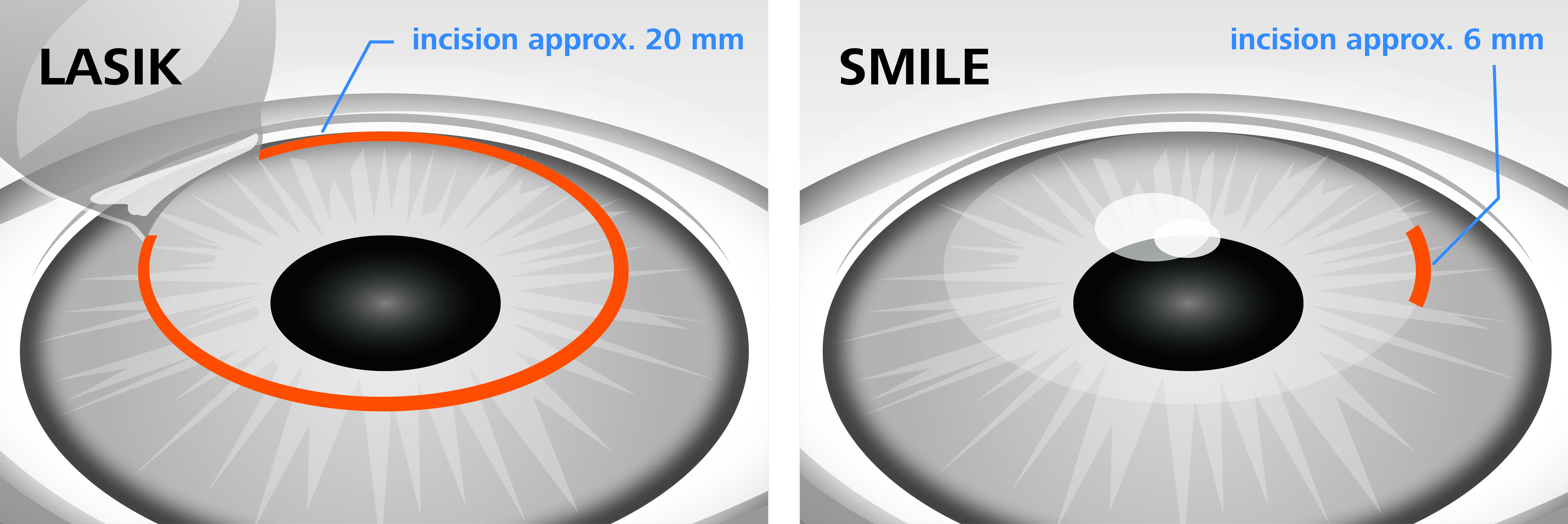Коррекция зрения сравнение. Метод ласик лазерная коррекция. Лазерная коррекция зрения метод Фемто ласик. Операция Femto LASIK И smile. RELEX smile лазерная коррекция зрения.