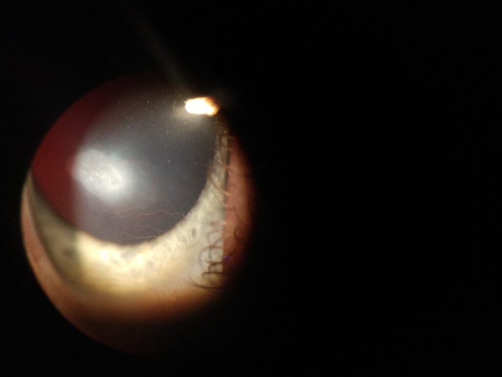 소아 안검각결막염 - Northwest Eye Surgeons 소아 안검각결막염 - Northwest Eye Surgeons